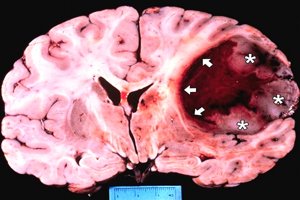 Đặc điểm hình ảnh MRI của u nguyên bào thần kinh đệm