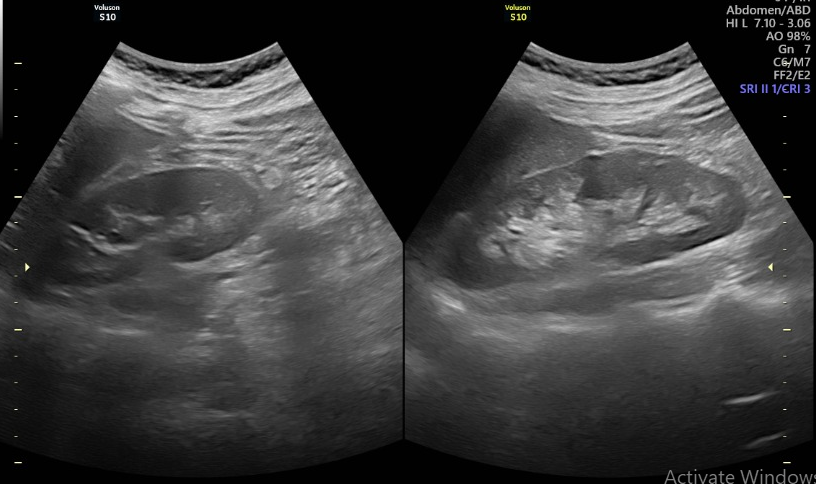 4. Ứng dụng siêu âm hệ tiết niệu trong chẩn đoán