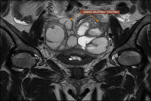 Đánh giá bệnh lý viêm - ứ dịch vòi trứng bằng phương pháp chụp MRI